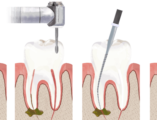 How to Search for Painless Root Canal Therapy in Toronto