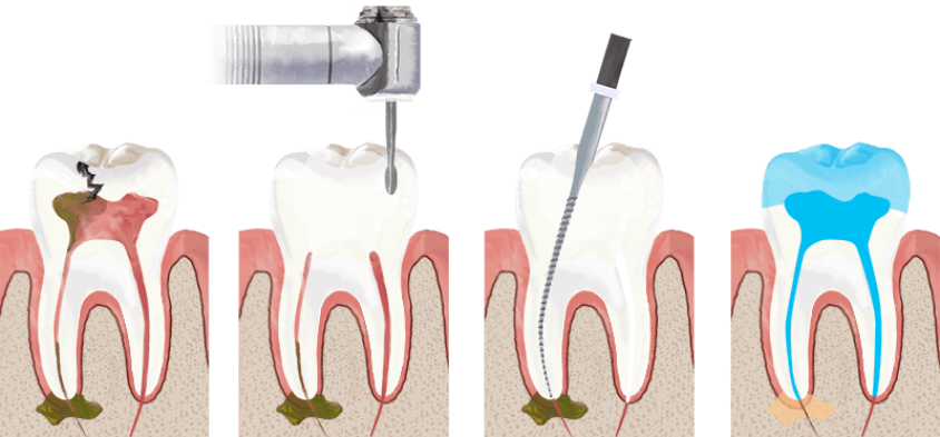 root-canal