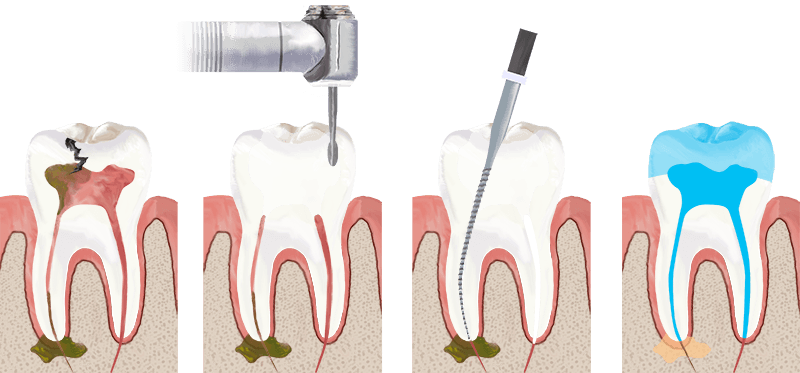 How to Search for Painless Root Canal Therapy in Toronto